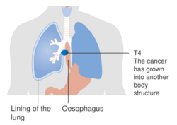 Diagram showing stage T4 oesophagus cancer CRUK 271.svg