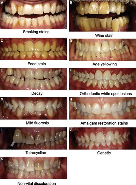 File:Examples of tooth staining.jpg
