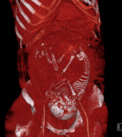 Volume rendered CT scan of a pregnancy of 37 weeks of gestational age (smaller).gif