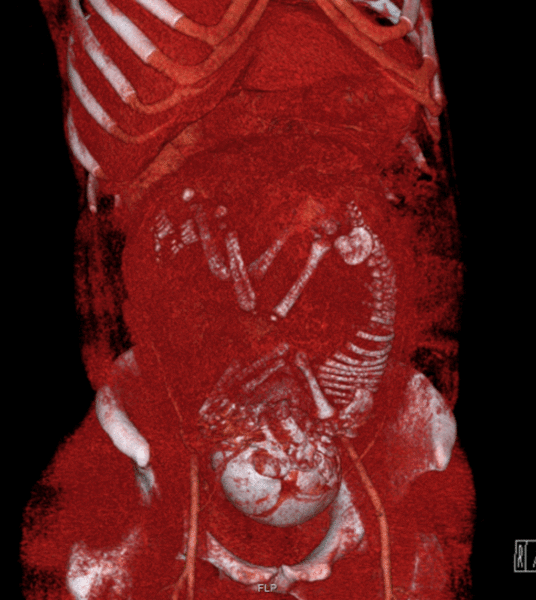 File:Volume rendered CT scan of a pregnancy of 37 weeks of gestational age (smaller).gif