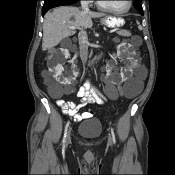 File:CT scan autosomal dominant polycystic kidney disease.jpg