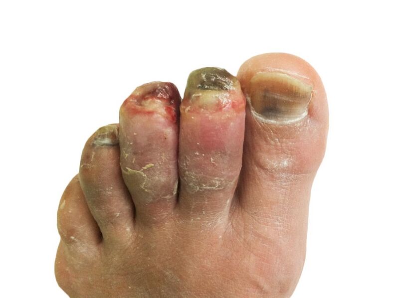 File:Human toes, 3 weeks post-frostbite.jpg