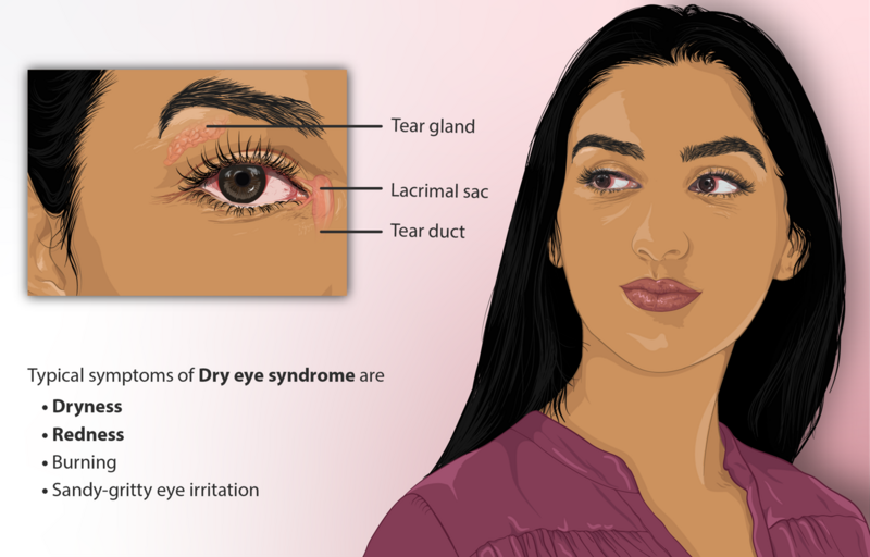 File:Depiction of a person suffering from Dry Eye Syndrome.png