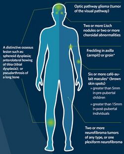 Diagnostic criteria of neurofibromatosis type I.jpg