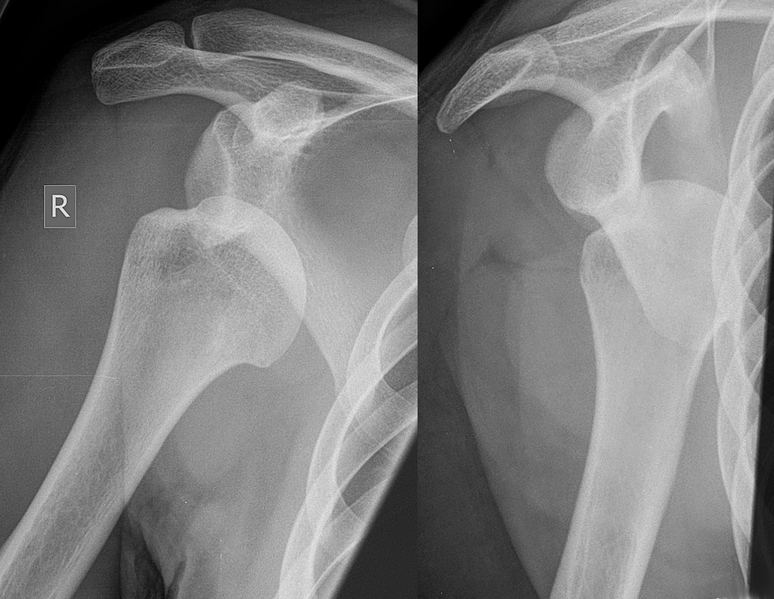 File:Dislocated shoulder X-ray 03.png