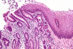 Pancreatic acinar metaplasia - high mag.jpg