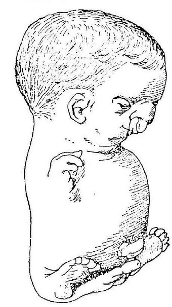 Virchow fetus 1898.JPG