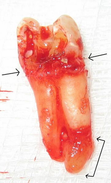 File:Chronic apical periodontitis (with arrows).jpg
