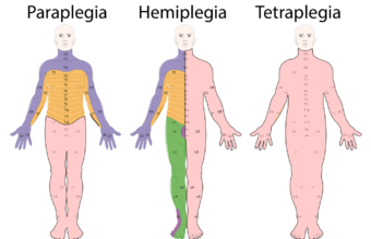 Neurological Levels & Types of Paralysis.png