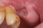 clinical photograph of a well healed socket