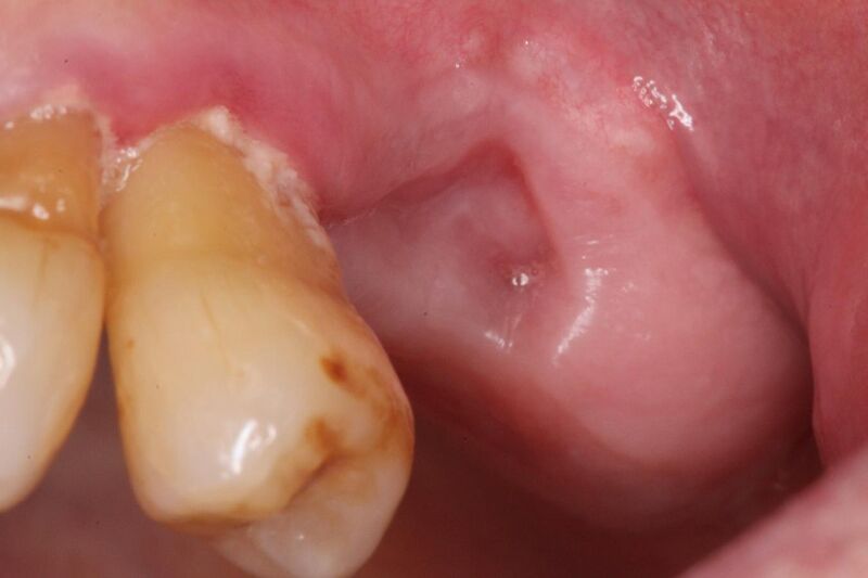 File:Well healed extraction socket.jpg