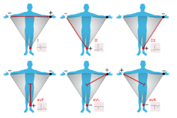 Limb leads of EKG.png