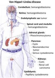 Cysts and tumors in Von Hippel–Lindau disease.png