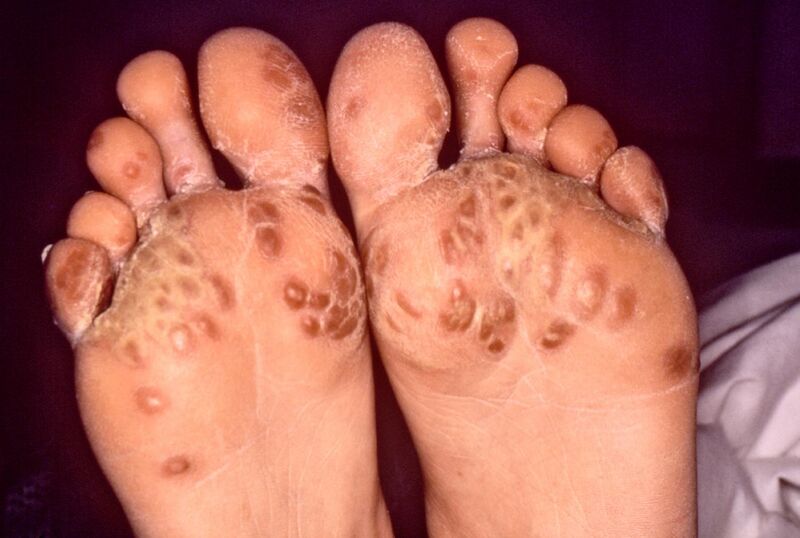 File:Feet-Reiters syndrome.jpg