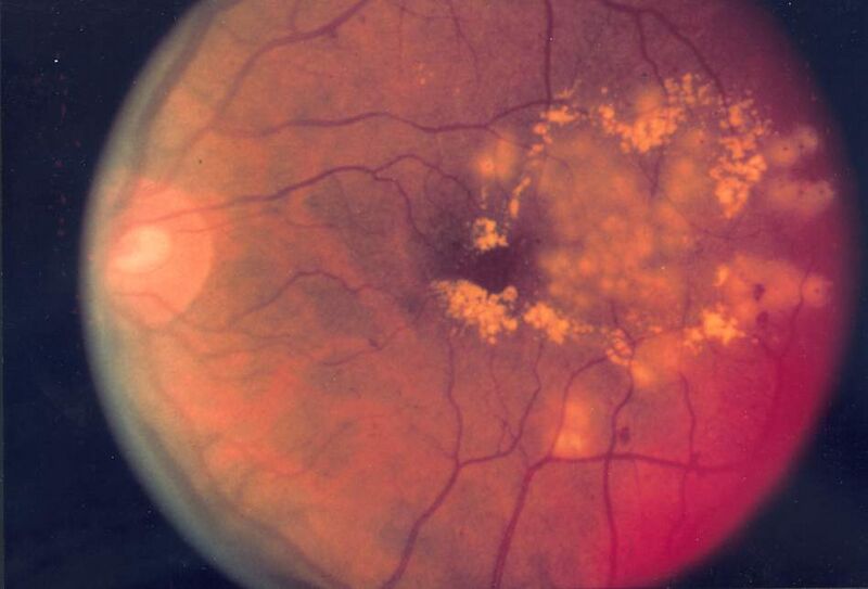 File:Fundus photo showing focal laser surgery for diabetic retinopathy EDA10.JPG