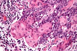 NUT midline carcinoma - very high mag.jpg