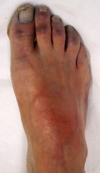 File:Peripheral Cyanosis due to Ischemia.jpg