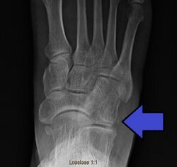 CuboidAvulsionFracture.jpg