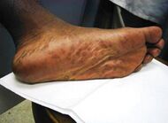 Secondary stage syphilis sores (lesions) on the soles of the feet. Plantar lesions-CDC.jpg