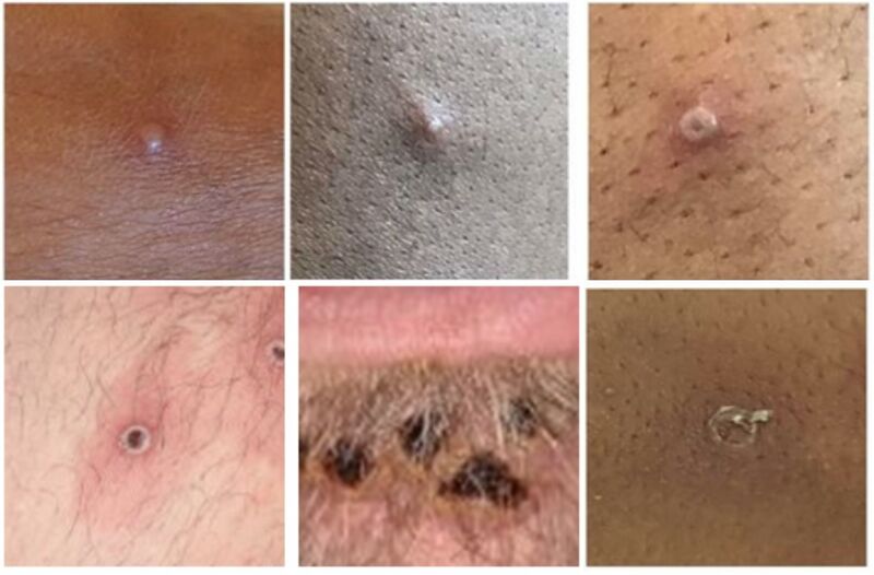 File:Stages of monkeypox lesion development.jpg