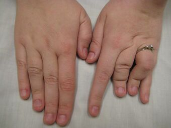 Hands of a person with Larsen syndrome.jpg