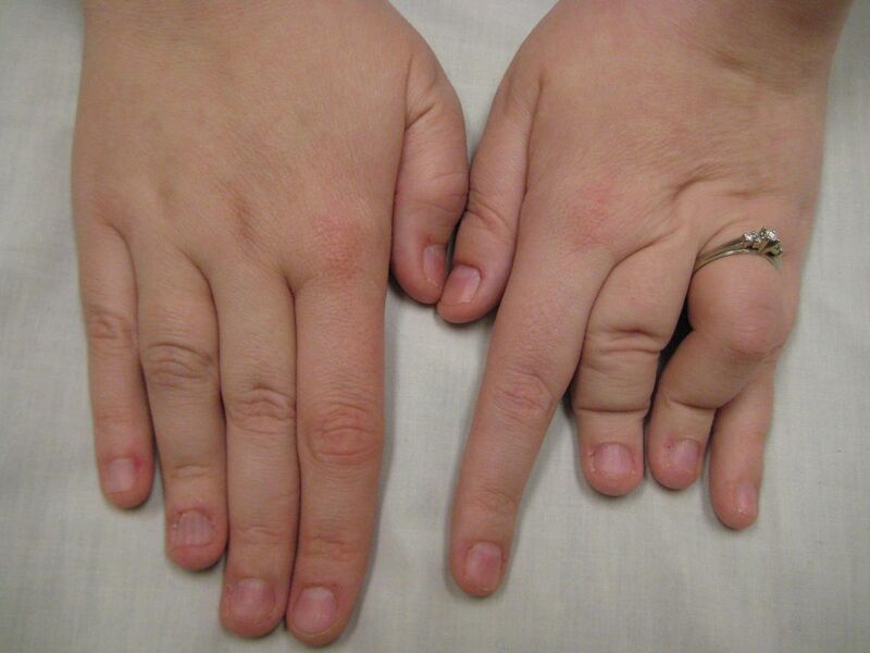 File:Hands of a person with Larsen syndrome.jpg