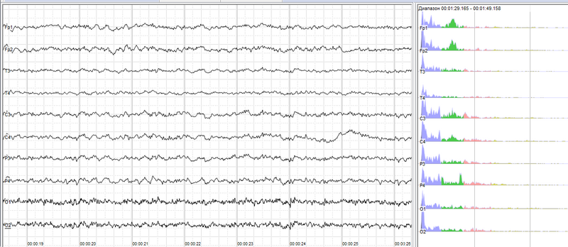 File:Human EEG without alpha-rhythm.png