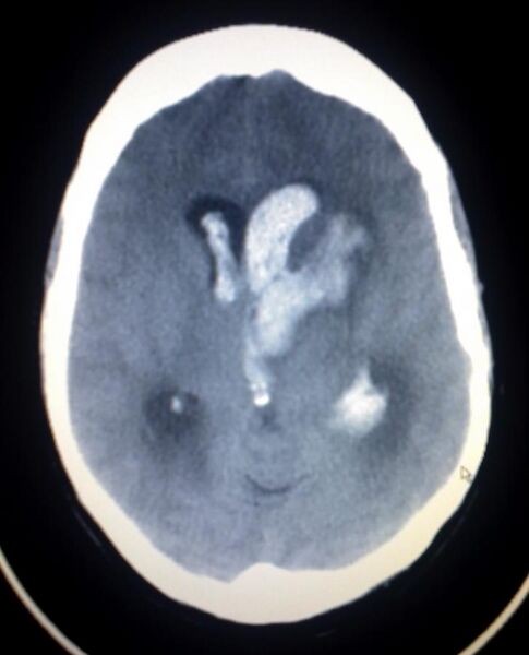 File:Intracerebral hemorrage (CT scan).jpg