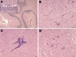 Nonsuppurative encephalitis in goat affected by louping ill.jpg