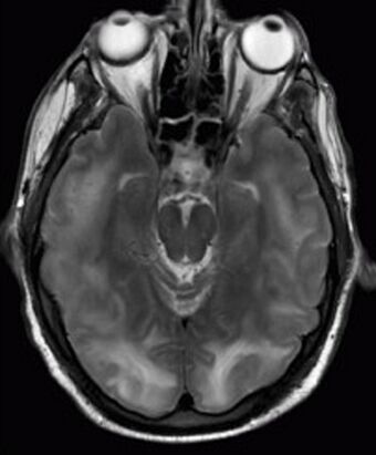 Posterior reversible encephalopathy syndrome MRI.jpg