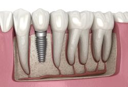 Dental-implant-illustration.jpg