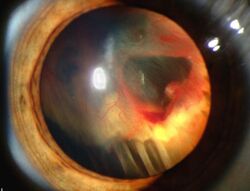 Retinal detachment in Von Hippel-Lindau disease.jpg