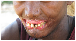 Man with severe scars around mouth, no lips