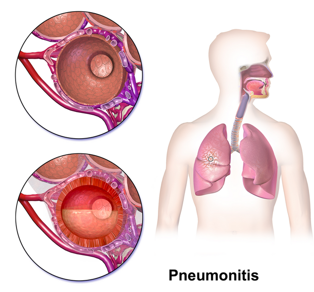 File:Pneumonitis.png