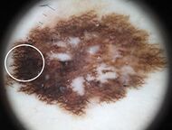 Superficial spreading melanoma in situ on dermoscopy.jpg