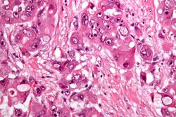 Fibrolamellar hepatocellular carcinoma -2- very high mag.jpg