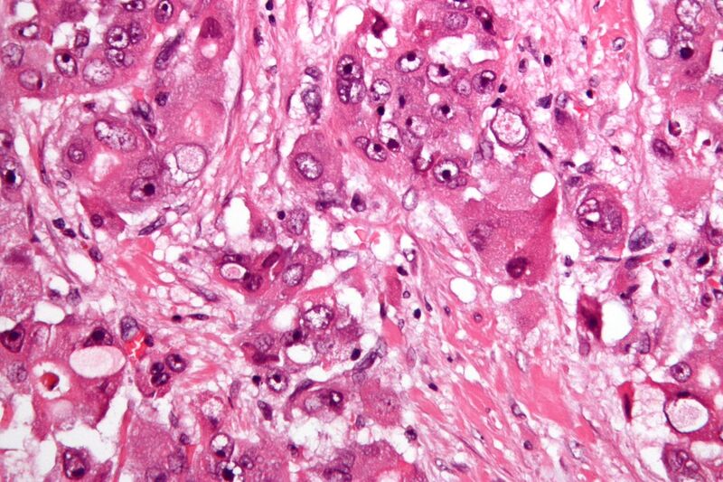 File:Fibrolamellar hepatocellular carcinoma -2- very high mag.jpg