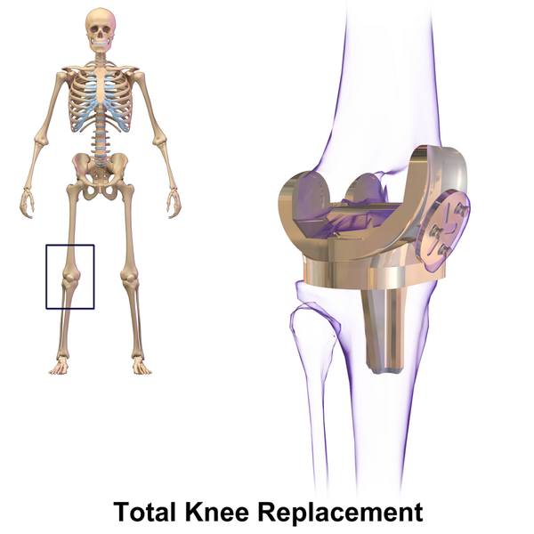 File:Knee Replacement.png