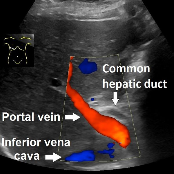 File:Ultrasonography of common hepatic duct, labeled.jpg