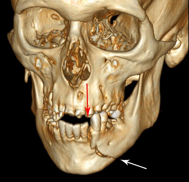 File:3D CT mandible fracture.jpg