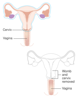 Diagram showing parts of the body removed with a radical hysterectomy CRUK 180.svg