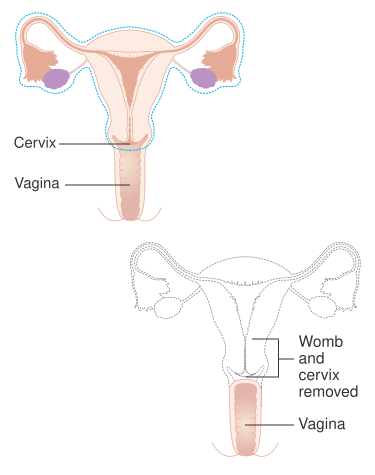 File:Diagram showing parts of the body removed with a radical hysterectomy CRUK 180.svg