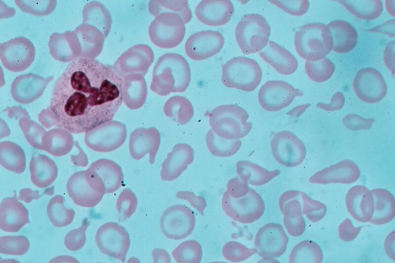 File:Fe- deficient anemia.jpg