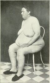 Naked woman with lipomatous Frohlich's syndrome.jpg