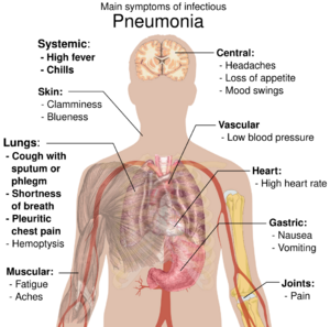 Illustration of pneumonia symptoms on a human body