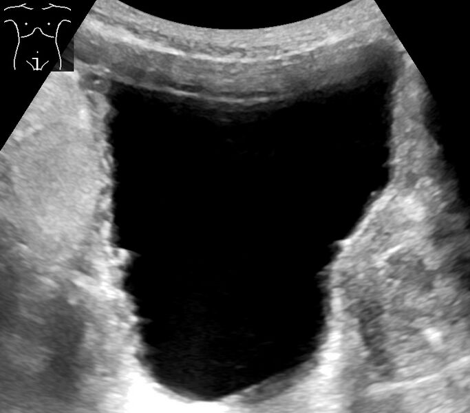 File:Ultrasound of trabeculated urinary bladder.jpg
