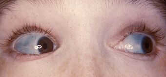 Characteristically blue sclerae of patient with osteogenesis imperfecta.jpg