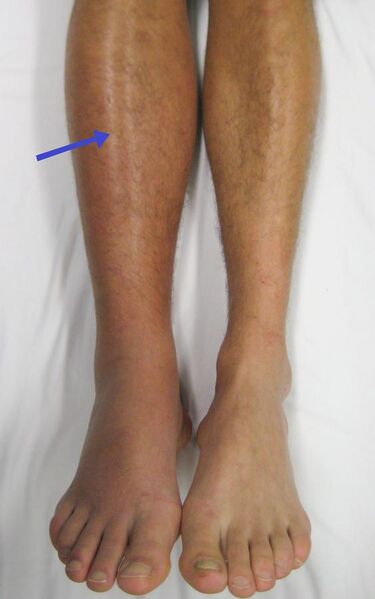 File:Deep vein thrombosis of the right leg.jpg