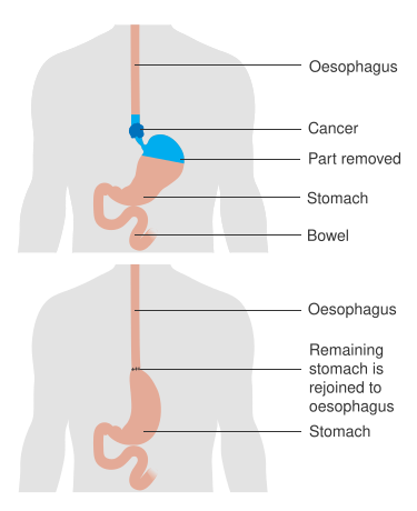 File:Diagram showing before and after an oesophago-gastrectomy CRUK 107.svg