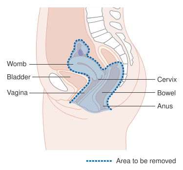 File:Diagram showing the area removed with a posterior exenteration for cancer of the cervix CRUK 288.svg